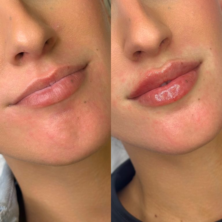 antes y despues de un aumento de labios en clinica de medicina estetica en Cadiz